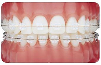 braces clear brackets bottom bracket invisible orthodontic ligating self ceramic private teeth fixed orthodontist adult system orthodontics both placed need