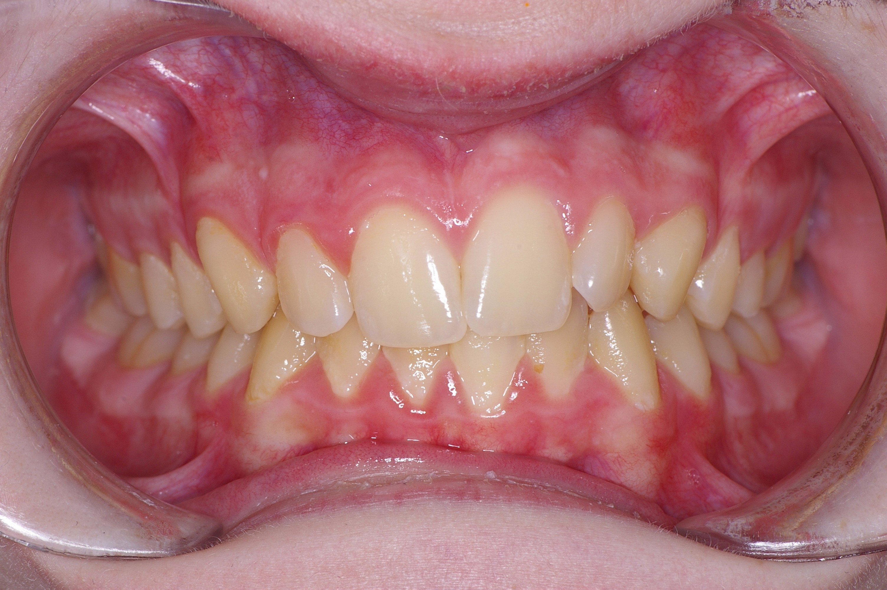 invisalign treatment before costs need know