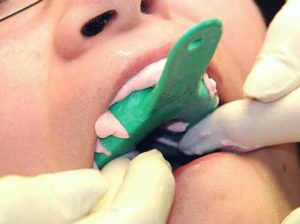 Maxillary-Impression-in-Mouth