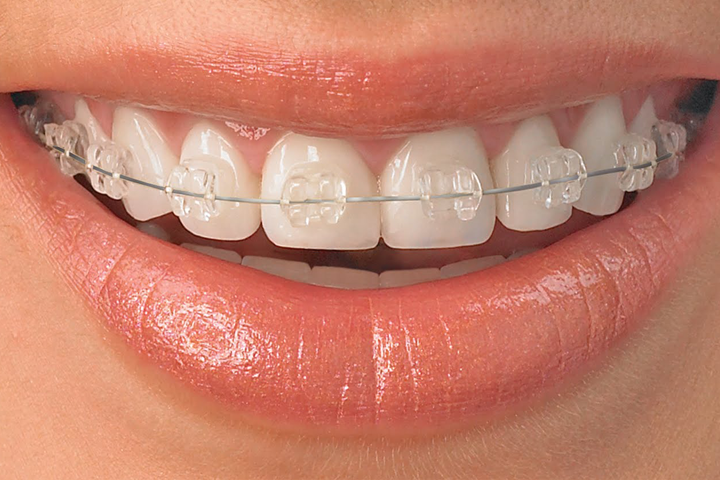 Traditional Braces Bloomfield, Orthodontics