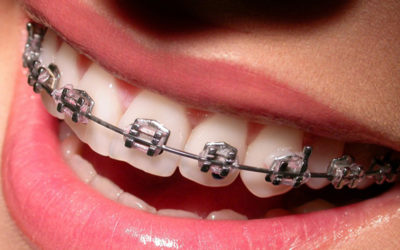 How to Care for Your Braces: Tips for a Smooth Treatment
