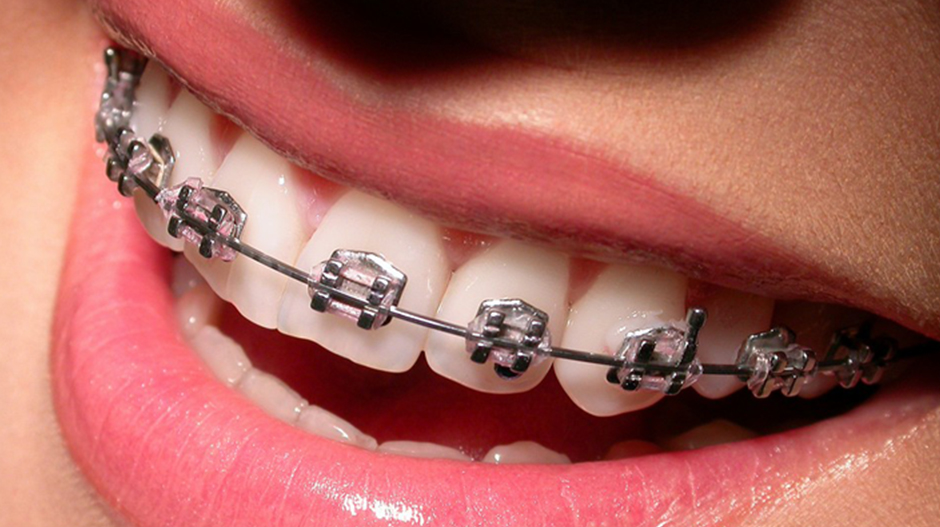 Papasikos Orthodontics Metal Braces