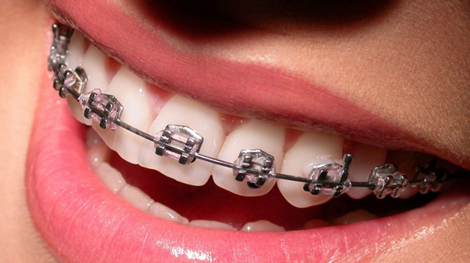 Metal Braces in Maplewood, NJ