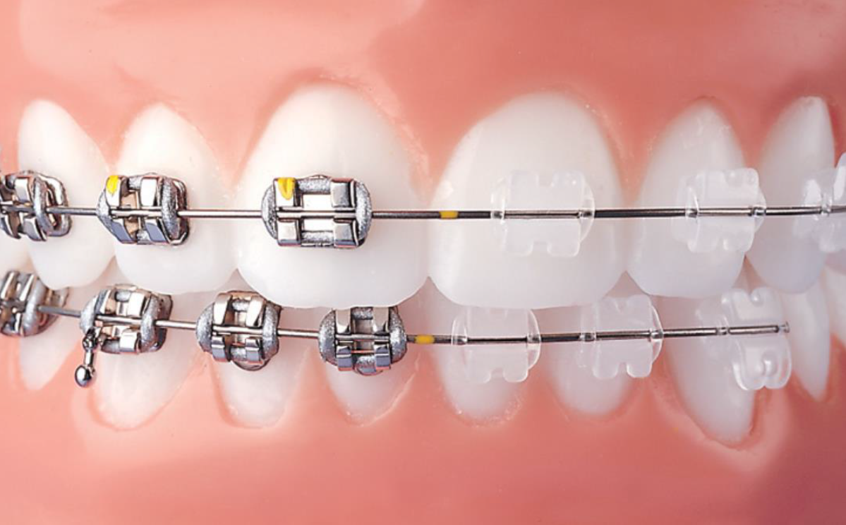 clear braces bands