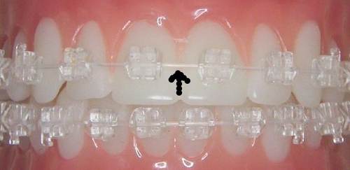 clear braces bands