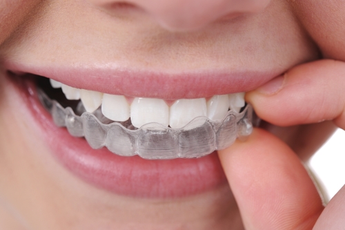 invisalign blog photo 1