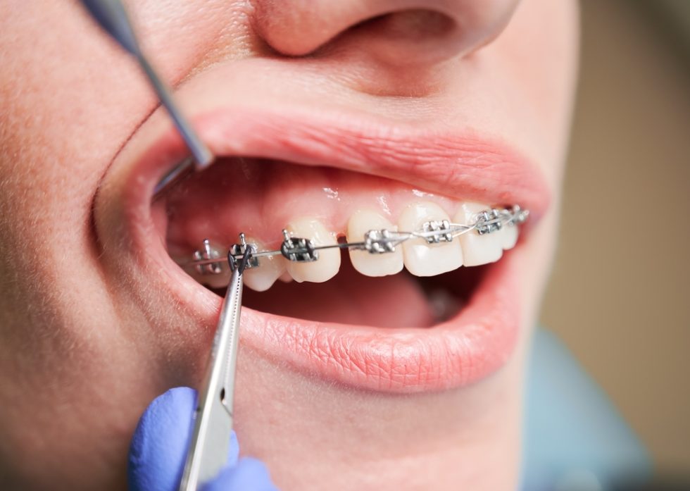 Broken Wire? Contact Papasikos Orthodontics! Montclair NJ Orthodontist