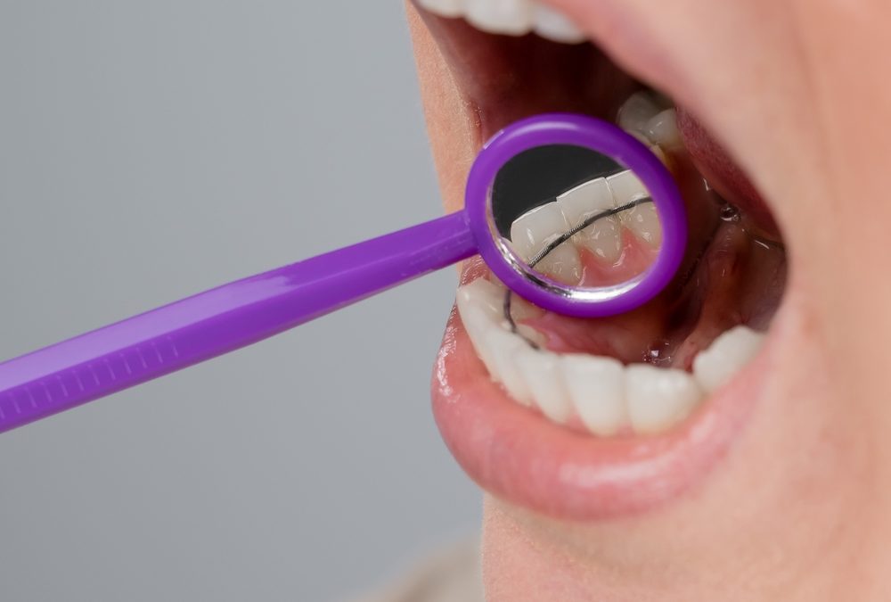 Preventing Gum Disease While Wearing Braces