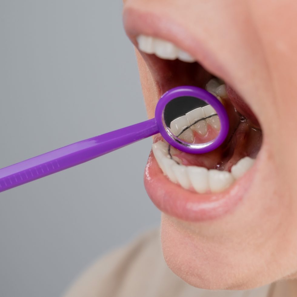 Preventing Gum Disease While Wearing Braces Papasikos Orthodontics