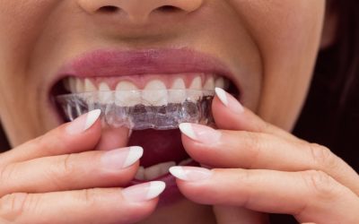 Do I Need a New Retainer?