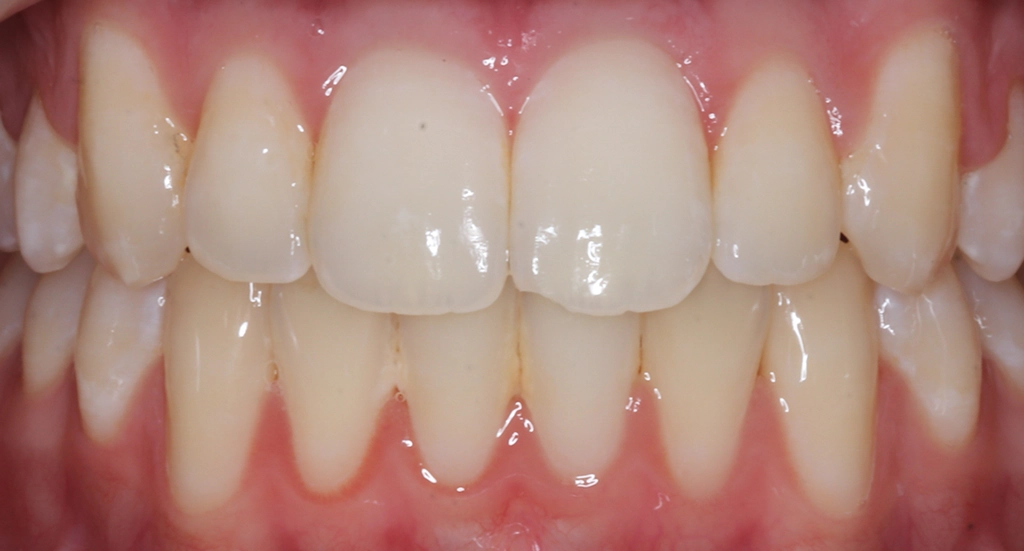 Crowding10TeethAfter10 Crowding10TeethAfter10
