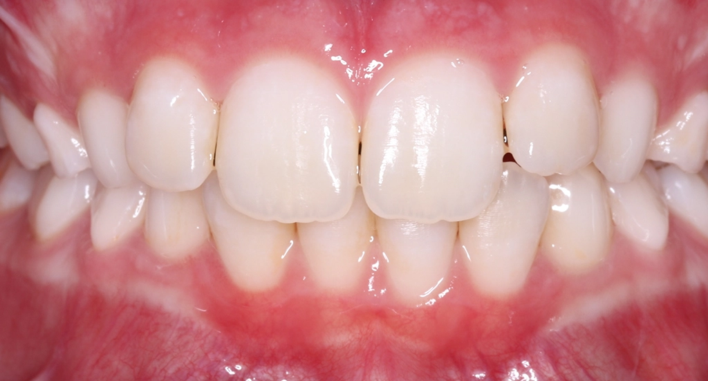 Crowding10TeethBefore10 Crowding10TeethBefore10