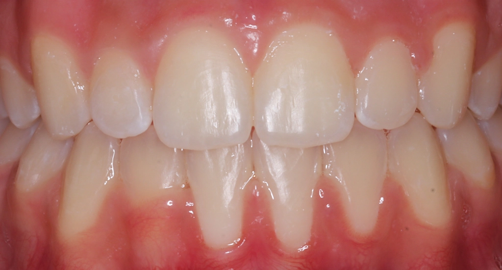 Crowding11TeethAfter11 Crowding11TeethAfter11