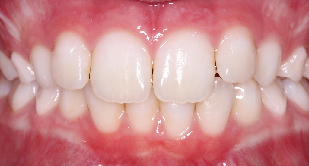 Crowding11TeethBefore11 Crowding11TeethBefore11