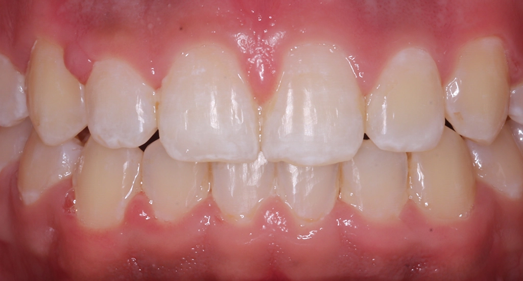 Crowding1TeethAfter1 Crowding1TeethAfter1