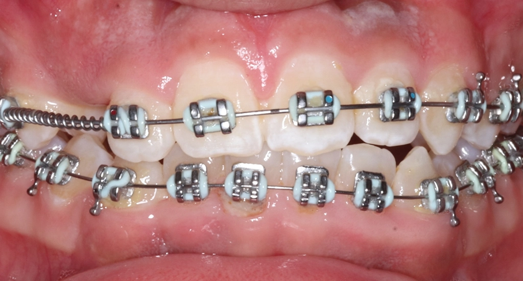Crowding1TeethBefore1 Crowding1TeethBefore1