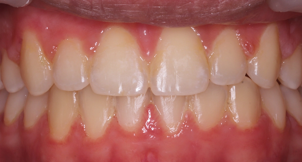 Crowding2TeethAfter2 Crowding2TeethAfter2