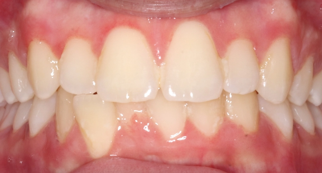 Crowding2TeethBefore2 Crowding2TeethBefore2