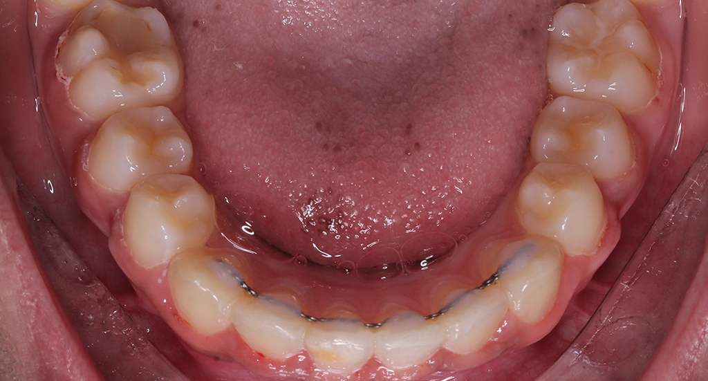 Crowding3TeethAfter3 Crowding3TeethAfter3
