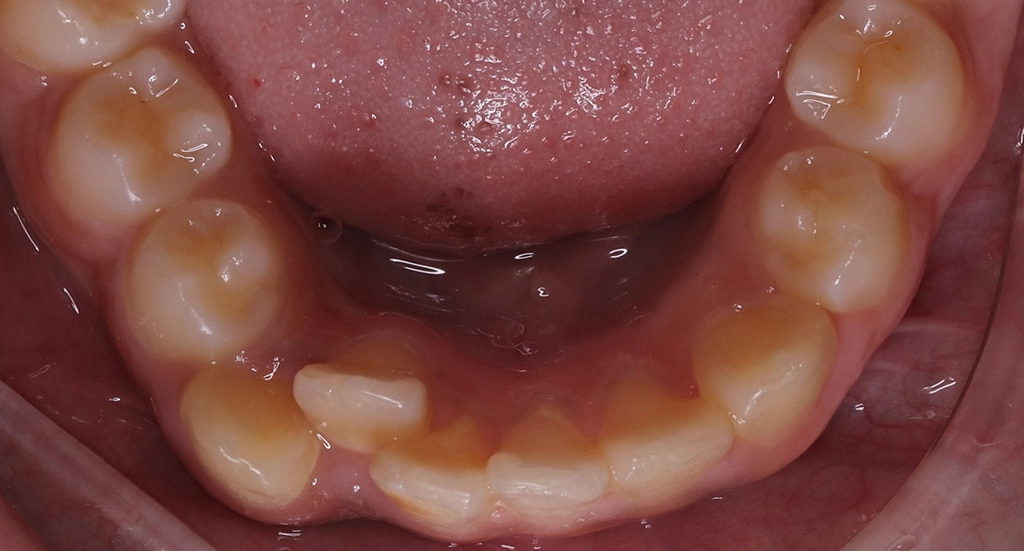 Crowding3TeethBefore3 Crowding3TeethBefore3