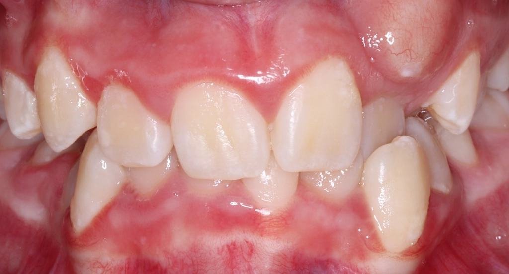 Crowding4TeethBefore4 Crowding4TeethBefore4
