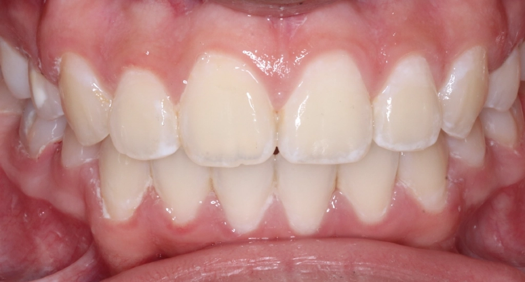 Crowding5TeethAfter5 Crowding5TeethAfter5
