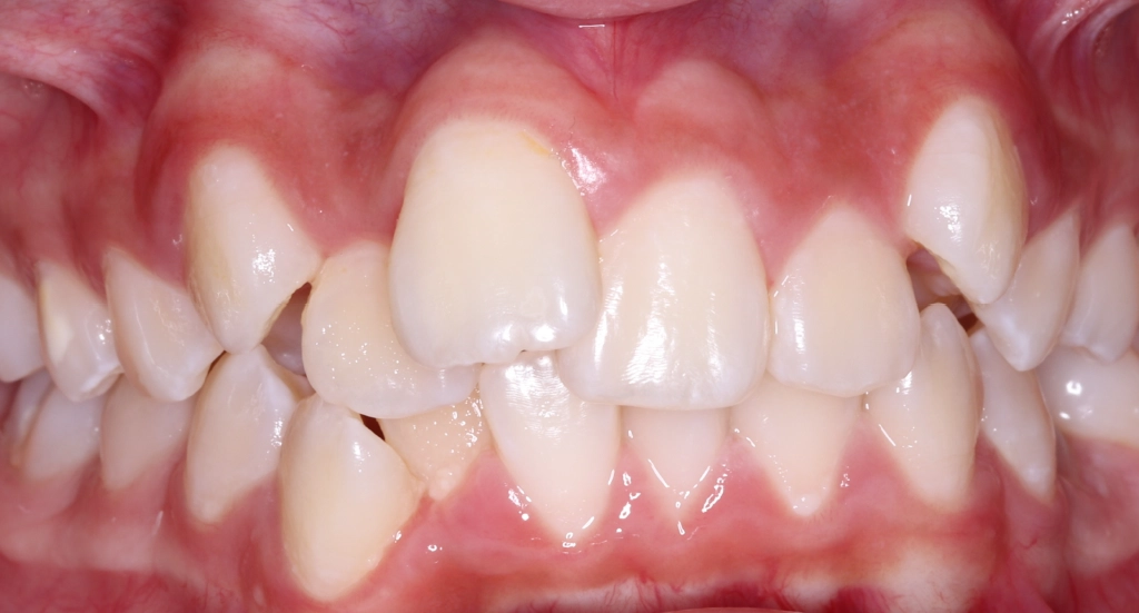 Crowding5TeethBefore5 Crowding5TeethBefore5
