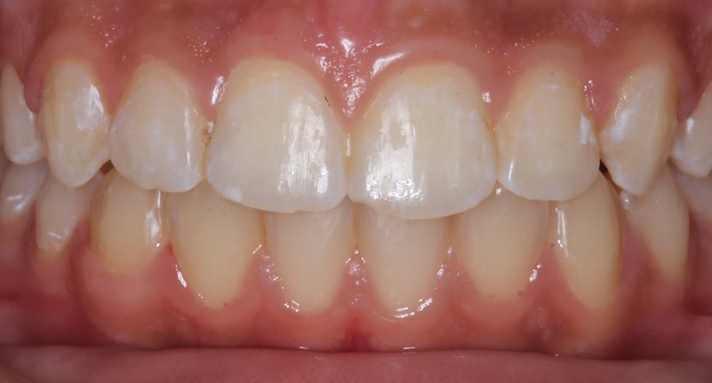 Crowding6TeethAfter6 Crowding6TeethAfter6