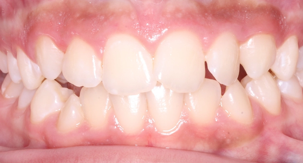 Crowding6TeethBefore6 Crowding6TeethBefore6