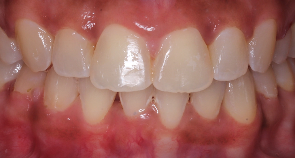Crowding7TeethAfter7 Crowding7TeethAfter7