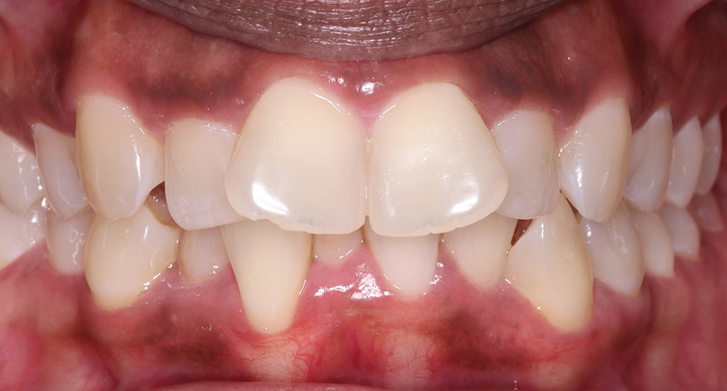 Crowding7TeethBefore7 Crowding7TeethBefore7