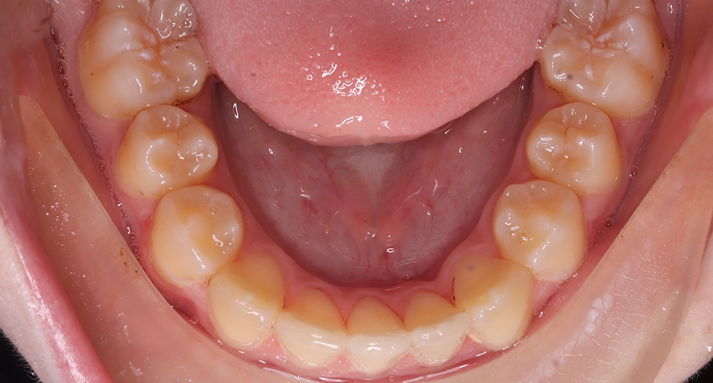 Crowding8TeethAfter8 Crowding8TeethAfter8