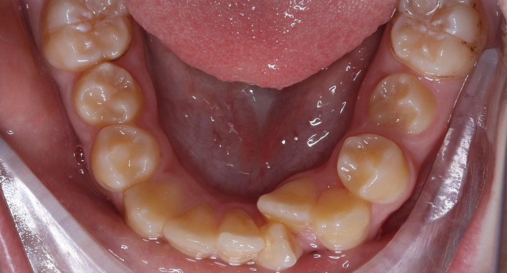Crowding8TeethBefore8 Crowding8TeethBefore8