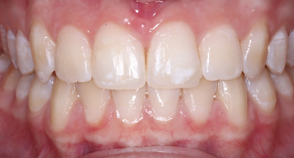 Crowding9TeethAfter9 Crowding9TeethAfter9