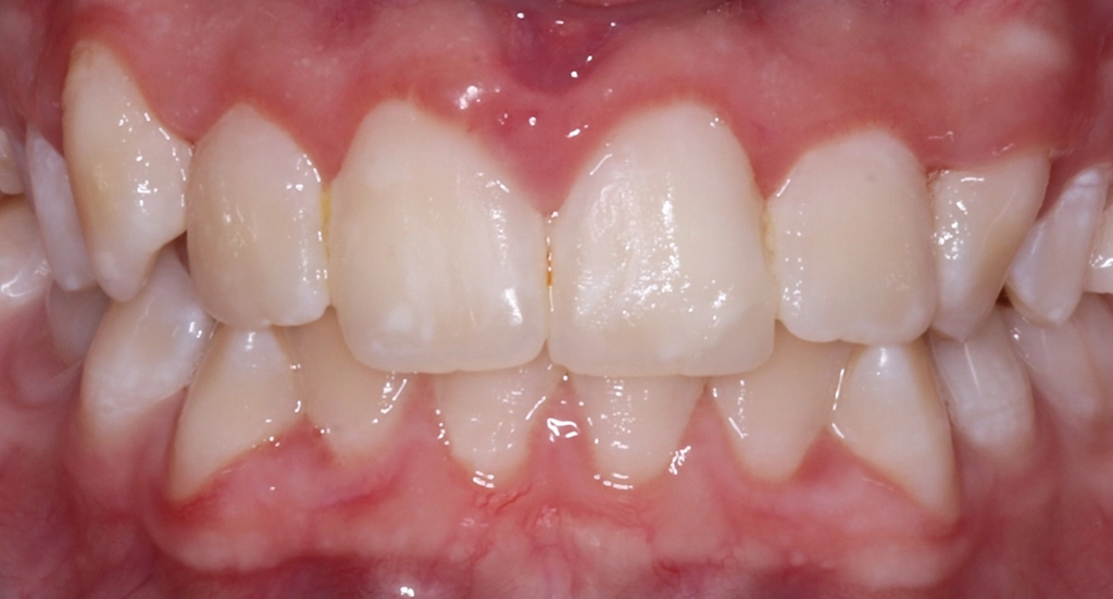 Crowding9TeethBefore9 Crowding9TeethBefore9