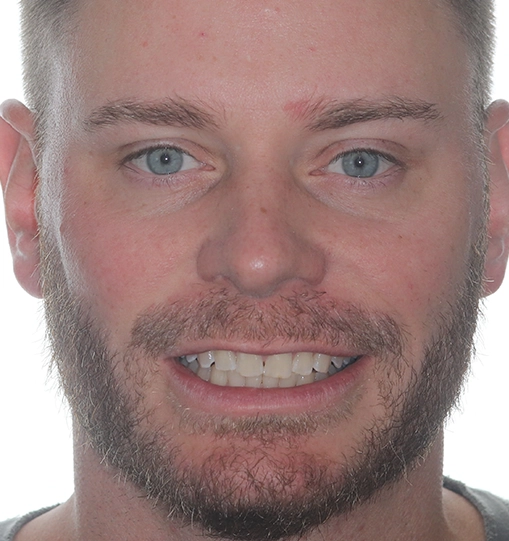 Invisalign10After Invisalign10After