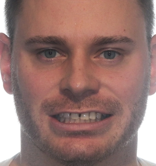 Invisalign10Before Invisalign10Before