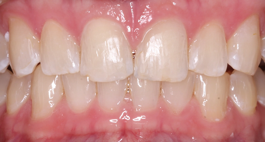 Invisalign10TeethAfter Invisalign10TeethAfter