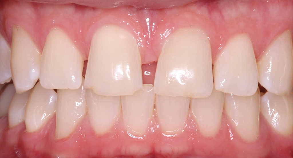 Invisalign10TeethBefore Invisalign10TeethBefore