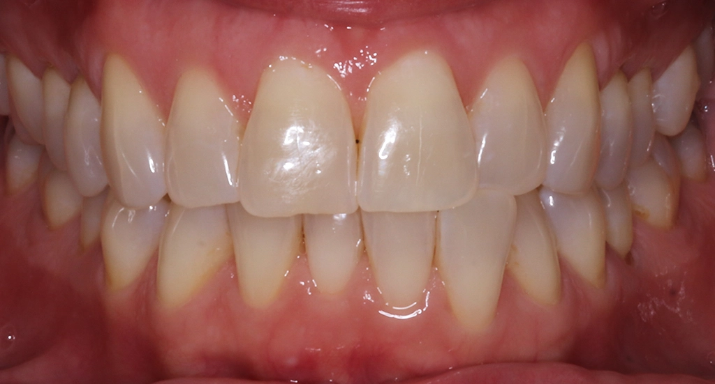 Invisalign1TeethBefore Invisalign1TeethBefore