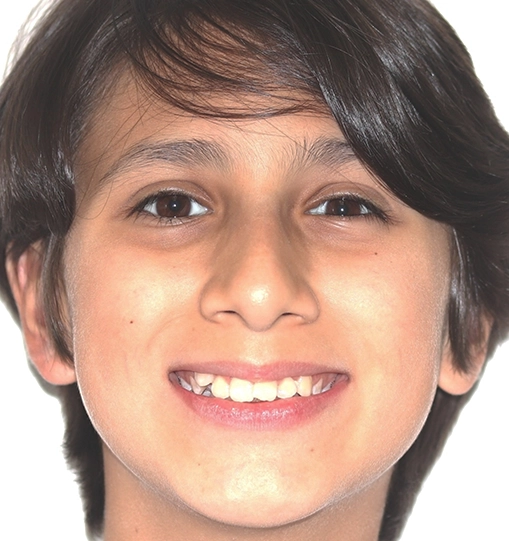 Invisalign2BeforePic Invisalign2BeforePic