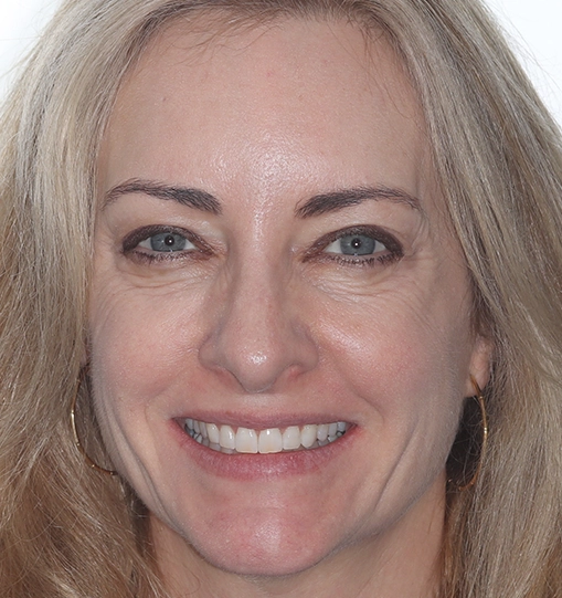 Invisalign3After Invisalign3After