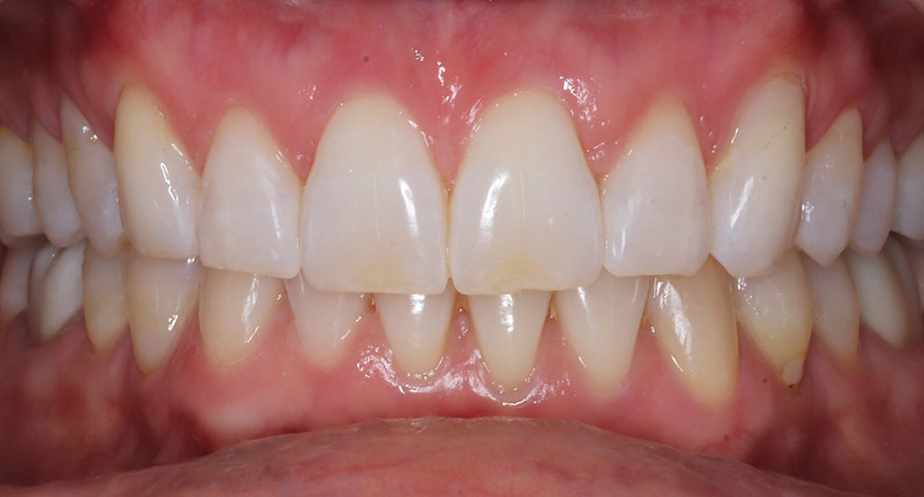 Invisalign3TeethAfter Invisalign3TeethAfter