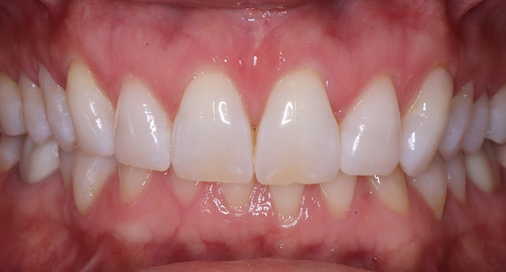 Invisalign3TeethBefore Invisalign3TeethBefore
