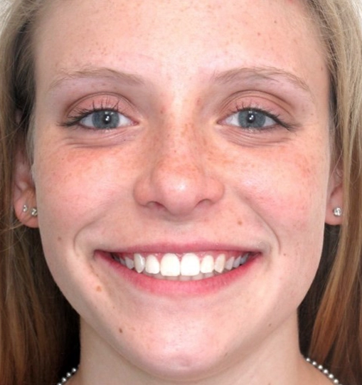 Invisalign4After Invisalign4After