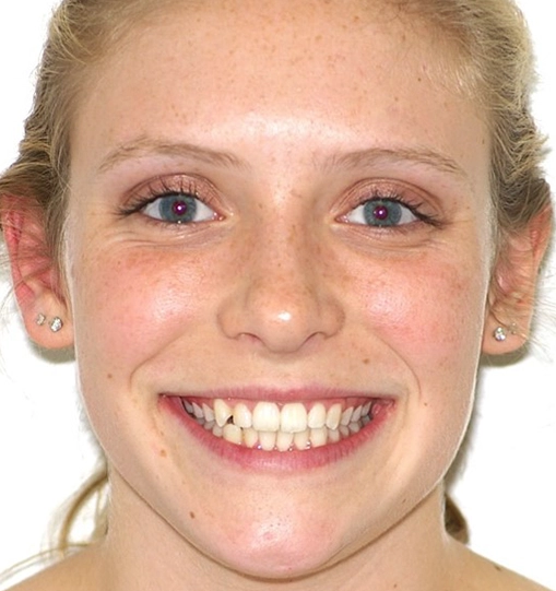 Invisalign4Beforey Invisalign4Beforey