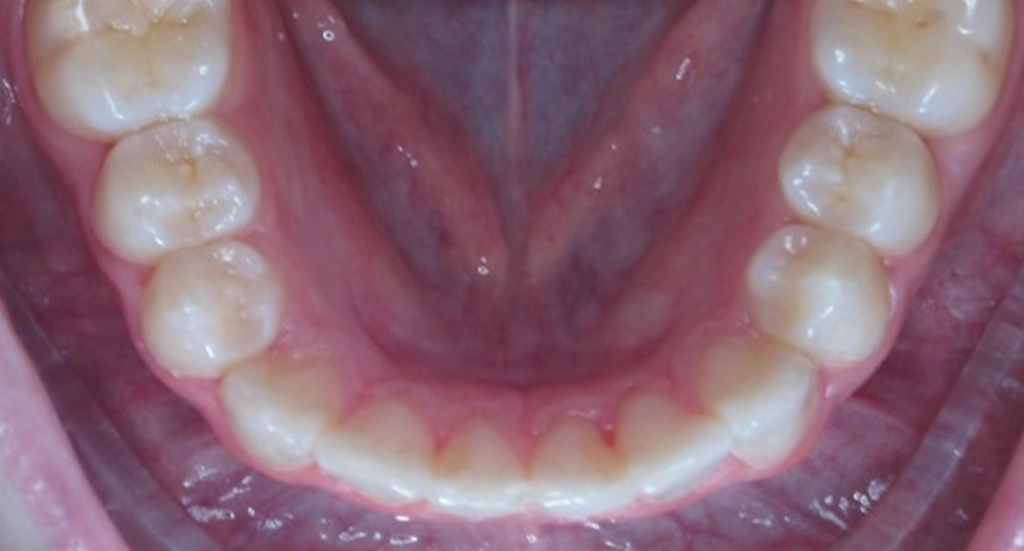 Invisalign4TeethAfter Invisalign4TeethAfter