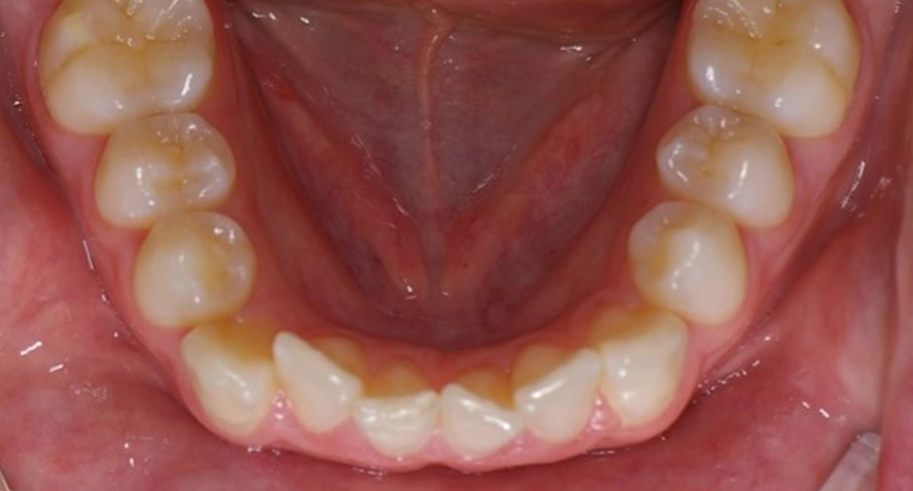 Invisalign4TeethBefore Invisalign4TeethBefore