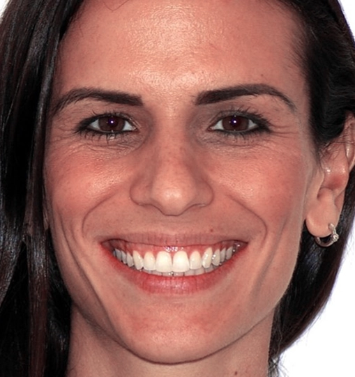 Invisalign5After Invisalign5After