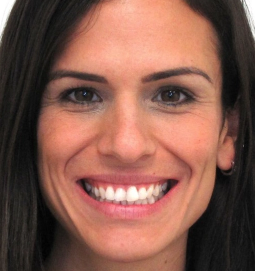 Invisalign5Before Invisalign5Before